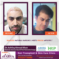 Permanent Hair Transplant at Elixir Hair Transplant Center Islalabad