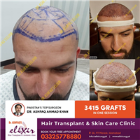 3415 Grafts in One Session By Dr. Ashfaq's Elixir Hair Clinic