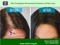 Hair Transplant Before And After